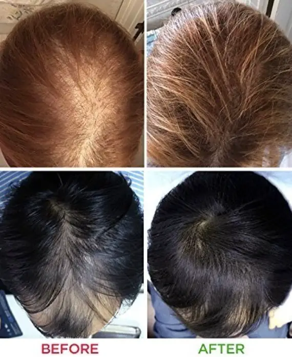 before and after light therapy hair treatment