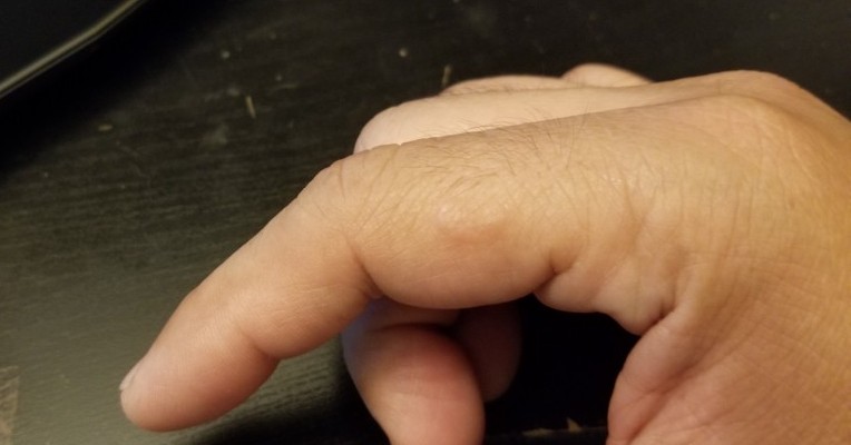 my finger on early signs of lupus
