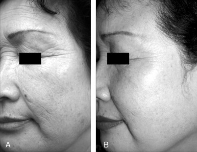 before and after picture of 6 months of infrared radiation treatment on face