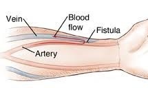 arteriovenous fistula internal picture inside hand