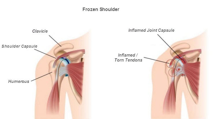 light therapy frozen shoulder