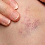 What Does It Look Like When a Vein Pops?