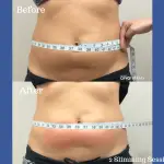 CryoSkin-Slimming-Before-After-6