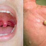 What-are-Tonsil-Stones-722×406-1
