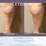 cryoskin-toning-thighs-before-and-after